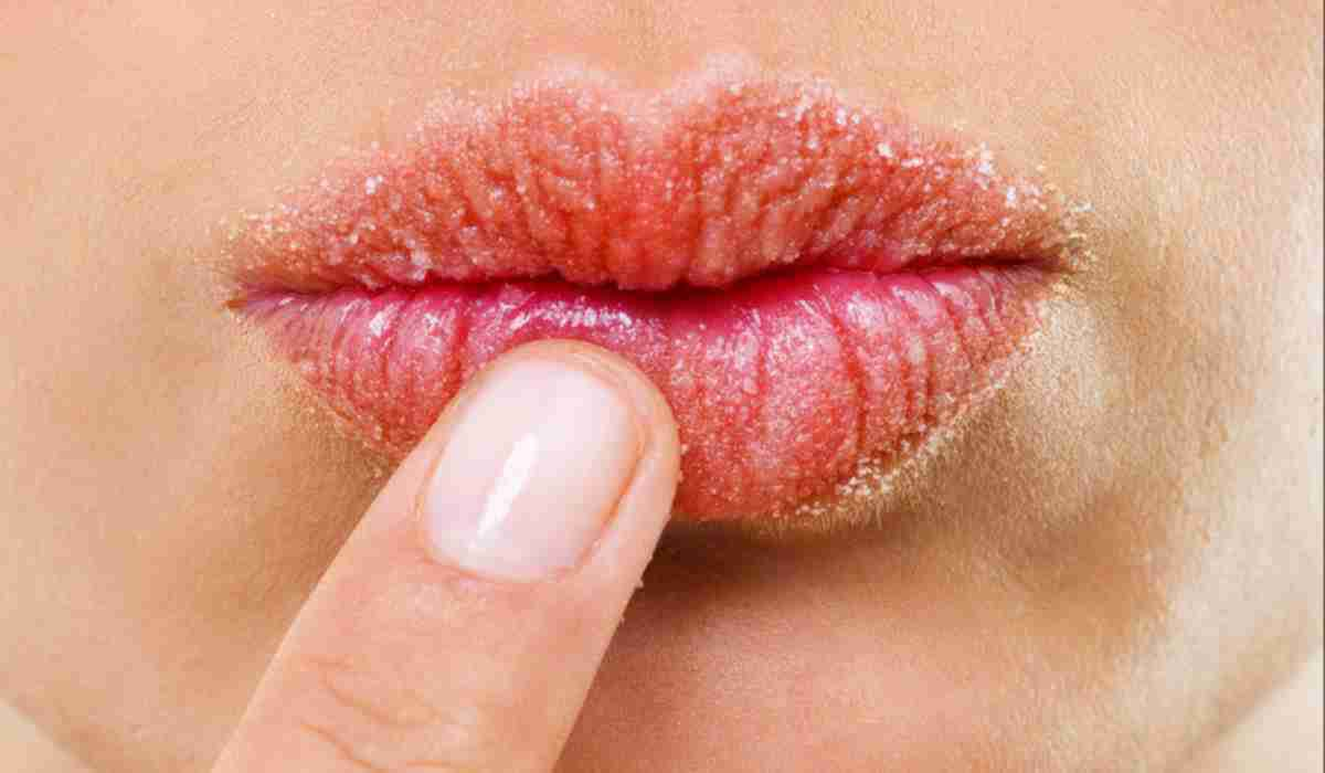 How to save chapped lips using a DIY honey-sugar scrub. Professional guide on removing dead skin, healing cracks, and winter lip protection for a healthy smile.